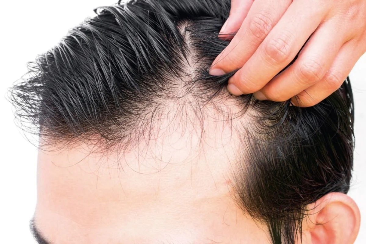 Alopecia masculina: cómo el estrés impacta en la caída capilar y qué tratamientos la combaten